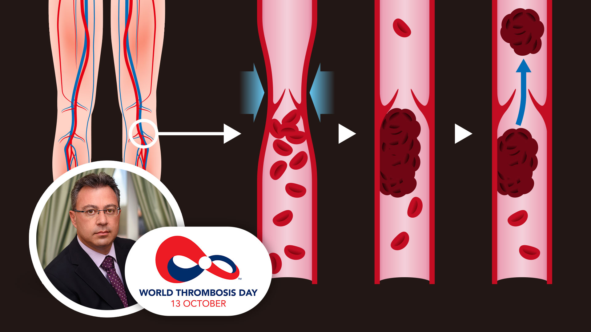 Παγκόσμια Ημέρα Θρόμβωσης: Πέντε φορές περισσότερες οι πιθανότητες θρόμβωσης για όσους έχουν κιρσούς